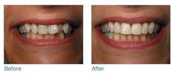 How to fix crooked teeth without braces uk. Six Month Smiles Marquess Dental Pwllgwyngyll Anglesey
