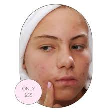 Teen Facial Treatment White Rock (+ Free Skincare Routine)