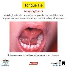 Image result for Ankyloglossia