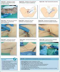 Maybe you would like to learn more about one of these? Care Of The Perineum In Labour Including Episiotomy And Suturing Nurse Key