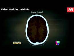 Las causas de muerte cerebral pueden ser múltiples, las mas usuales son el traumatismo encéfalo craneano, la hemorragia subaracnoídea y la isquemia cerebral global a causa de un paro. Muerte Cerebral Youtube