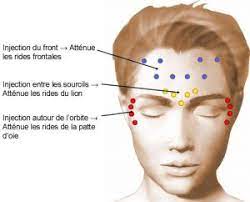 Many species of mammals and some fish can be affected by botulinum toxin. Supprimer Les Rides Du Front Par Injection Toxine Botulique