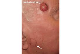 Merkel cell carcinoma is a skin cancer that is rare in type and needs immediate treatment. Clinical Photos Of Merkel Cell Carcinoma