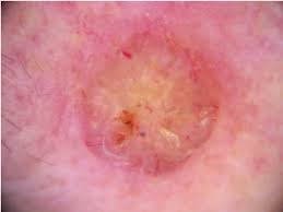 Image result for Dermoscopy