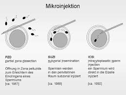 Wann einnistung nach transfer forum kinderwunschbehandlun. Behandlung Ivf Icsi Behandlung Bei Unerfulltem Kinderwunsch