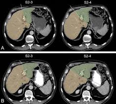 Het is nog niet zeker of van lienden logistiek ophoudt te bestaan, klinkt het. Functional And Volumetric Assessment Of Liver Segments After Portal Vein Embolization Differences In Hypertrophy Response Surgery