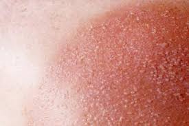 We did not find results for: Sun Poisoning Rash Lovetoknow