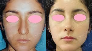 rinoplastia