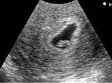 Suivez l'évolution de votre grossesse sur bébés et mamans ! Echographie Au Premier Trimestre De La Grossesse Wikipedia