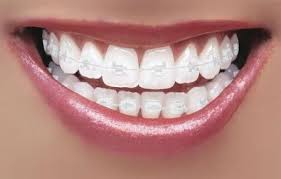 Pin On Fun In Braces