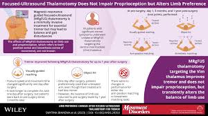 Image result for Thalamotomy