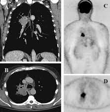 The tracer collects in the bone over a few hours, then the scans are done. Pet Scan In Lung Cancer Current Recommendations And Innovation Journal Of Thoracic Oncology