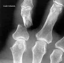 Image result for Hand Fracture