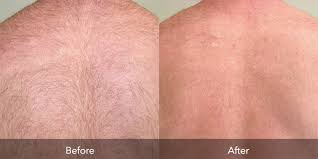 The hair will slowly be presented to the surface of your skin and then will fall out. Laser Hair Removal Flawless Body Skin Body Laser Aesthetics
