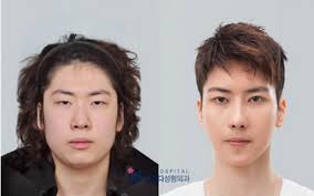 19 Mind Blowing Before And After Faces From South Korea's Plastic Surgery  Show!