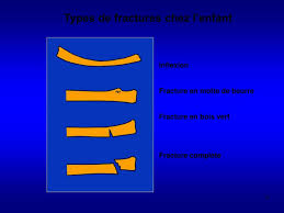 Ppt Fractures Powerpoint Presentation Free Download Id 4699500