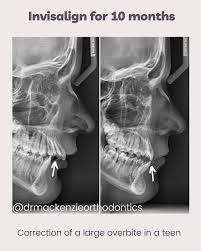 Orthodontic treatment options for overbite correction have not been very appealing. Mackenzie Orthodontics Home Facebook