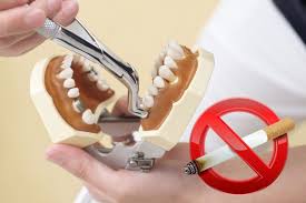 Image result for Tooth Extraction