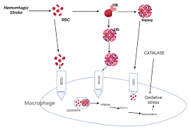 Image result for Stroke Pathophysiology