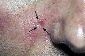 Image result for skin cancer on nose pimple