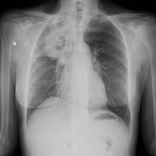 Review of literature and proposal of new diagnostic and classification criteria. Airway Invasive Aspergillosis Radiology Case Radiopaedia Org