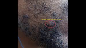 Facial hair bumps, also known as razor bumps, appear on your skin shortly after shaving and are caused by shaving in the opposite direction of the facial hair's growth and the hair being trapped in the skin. Beard Acne Black Men S Beard Saving Beard After Shaving Youtube