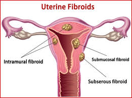 uterine fibroids ayurvedic treatment with herbal remedies