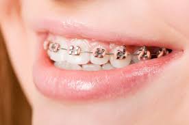 We did not find results for: How To Get Free Braces In Australia The No Cost Option For Braces Families Magazine