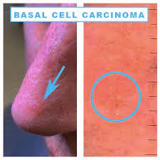 Basal cell carcinoma is the most common form of skin cancer, and least dangerous whereas melanoma (often referred to as. I Have A Spot Or Bump On The Nose What Could It Be Dr Sajjad Rajpar