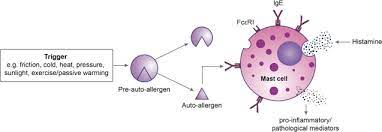 Explore the tslp investigation hub to learn more about severe asthma inflammation. Omalizumab Treatment In Patients With Chronic Inducible Urticaria A Systematic Review Of Published Evidence Journal Of Allergy And Clinical Immunology