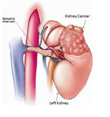 Peranan utamanya adalah bagi mengekalkan imbangan homeostatik cecair badan dengan penapisan dan penyingkiran metabolit (seperti urea) dan galian dari darah dan menyingkirkannya, bersama air, sebagai kencing.oleh kerana buah pinggang bersedia untuk mengesan kepekatan ion seperti natrium, kalium, hidrogen. Kanser Buah Pinggang Pusat Sumber Dan Pendidikan Kanser Care