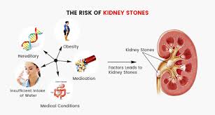 Kidney Stones Ouch Causes Symptoms Treatment Knoxville Hospital Clinics