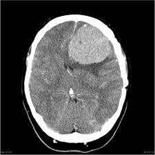 Viewing Playlist Ct Brain Ios Pack Radiopaedia Org The revolutionary new radiopad™ app allows you. viewing playlist ct brain ios pack
