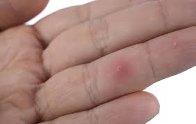 My baby has a cactus needle stuck in her finger. The Best Way To Remove A Splinter Men S Health