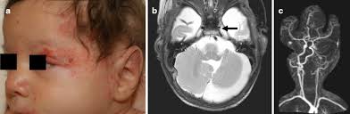Hemangiomas revisited: the useful, the unusual and the new Part 2:  endangering hemangiomas and treatment