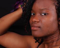 Hair loss and acne linked to PCOS in young women