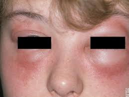 Angioedema Overview Altmeyers Encyclopedia Department Allergology