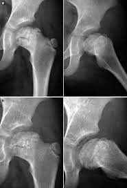 Cytoplasm vacuolization and microvillous hyperplasia. Legg Calve Perthes Disease Radiology Key