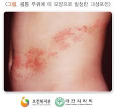 중증의 알레르기성·염증성 피부 질환의 치료제로 사용합니다. ëŒ€ìƒí¬ì§„