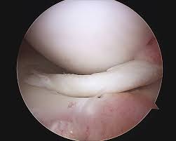 Operation Meniskusriss