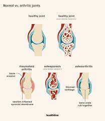 6 Home Remedies For Osteoarthritis