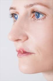 Status of art of epidemology, diagnosis, therapy and prevention. Signs And Symptoms Of Herpes