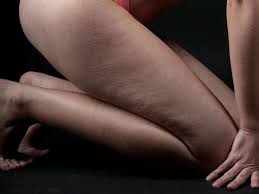 Il permet également d'éviter la. Retention D Eau 5 Remedes 100 Naturels