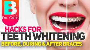 Here's how to whiten teeth with braces Braces Hacks To Keep Your Teeth White Teeth Whitening With Braces And Invisalign Youtube