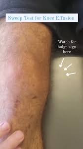 Image result for Knee Bulge Sign
