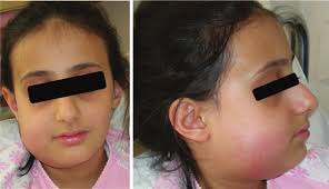 Length of Hospital Stay and Management of Facial Cellulitis of Odontogenic  Origin in Children