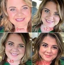 Rhinoplasty results for minor nose fixes in Turkey