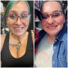 Right side comparison after 2 years vs left side after 1 month