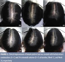 When male or female pattern baldness happens, rogaine is applied to help hair grow and stop hair loss. An Herbal Extract Combination Biochanin A Acetyl Tetrapeptide 3 And Ginseng Extracts Versus 3 Minoxidil Solution For The Treatment Of Androgenetic Alopecia A 24 Week Prospective Randomized Triple Blind Controlled Trial Jcad The