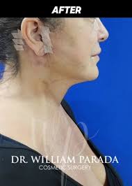 Matamoros face and arm lift experience